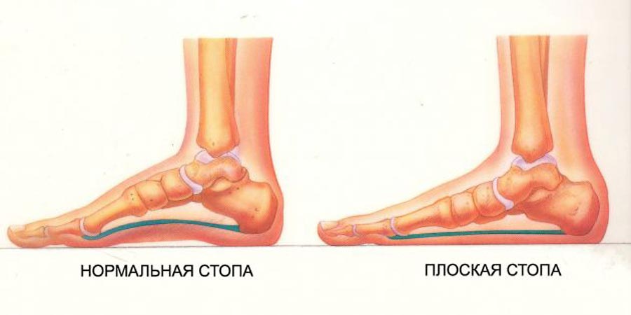 нормальная-стопа.jpg